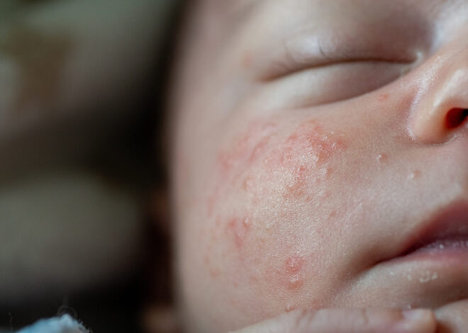 Don’t Worry, Mama: Understanding Newborn Pimples and Rashes