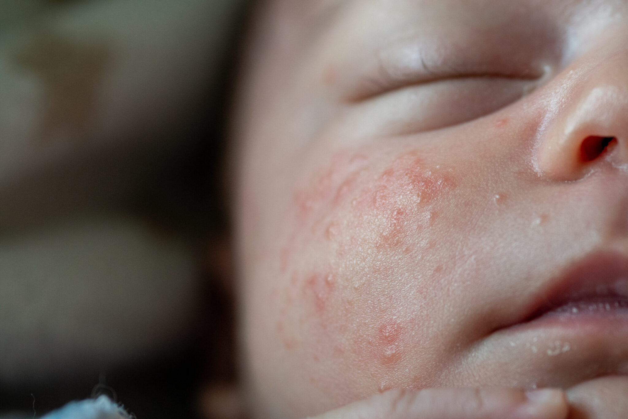 Don’t Worry, Mama: Understanding Newborn Pimples and Rashes