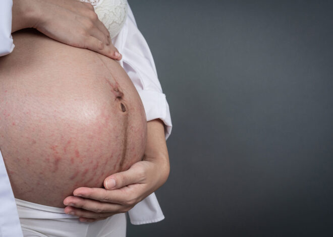 8 Ways to Minimize Pregnancy Stretch Marks: A Guide for New Moms