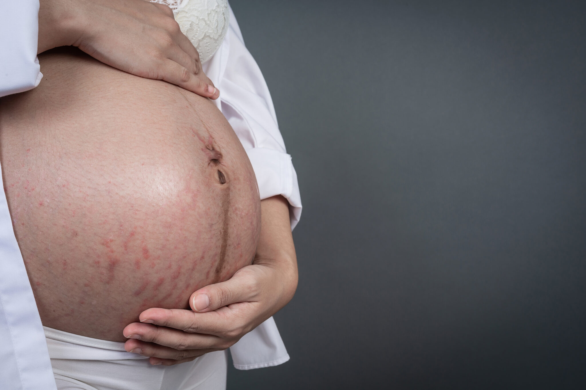 Pregnant woman with striped belly.