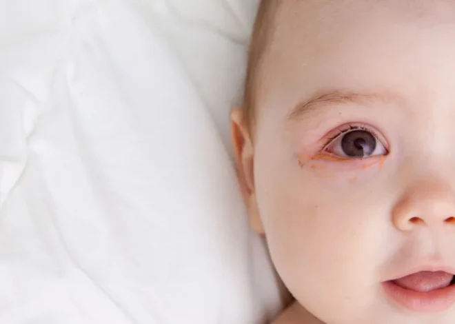 Why Does My Baby Have Redness Around Their Eyes? A Guide for New Moms