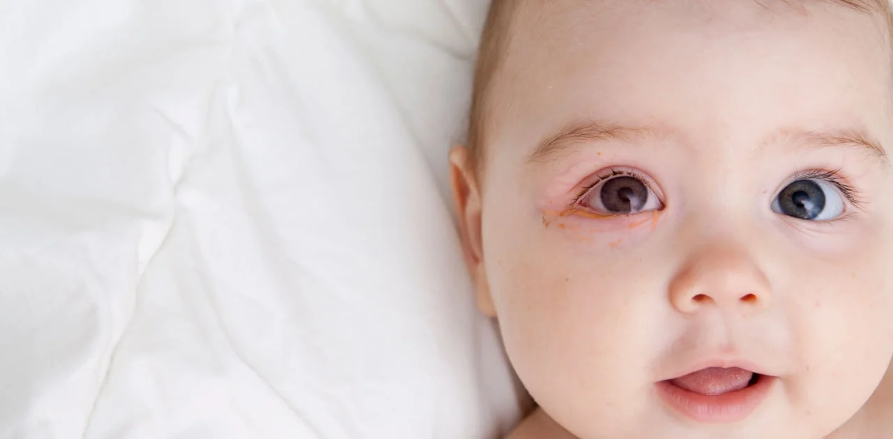 Why Does My Baby Have Redness Around Their Eyes? A Guide for New Moms