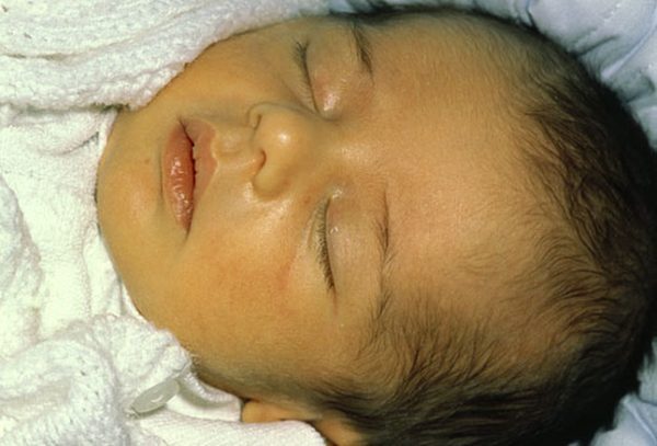 Jaundice in Newborns: Information and Tips for New Moms