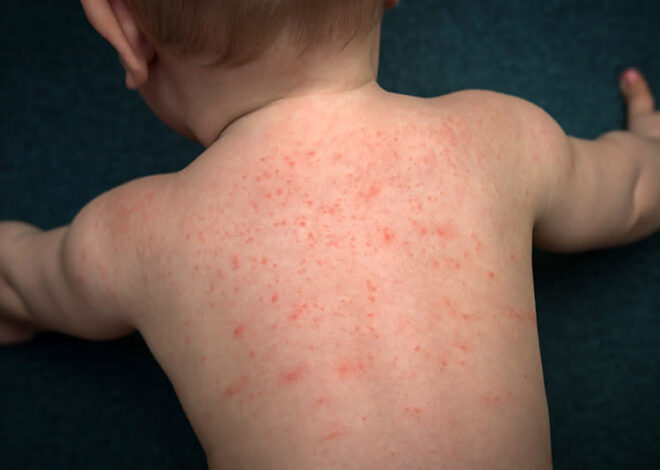 Don’t Panic, Mama: A Guide to Common Baby Rashes