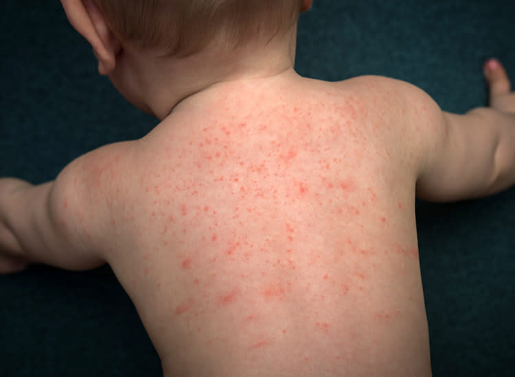 Don’t Panic, Mama: A Guide to Common Baby Rashes